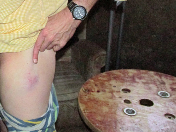 tom watson showing us the hurt he got last in san sebastian at casa tomada in la coruna, spain on march 4, 2014
